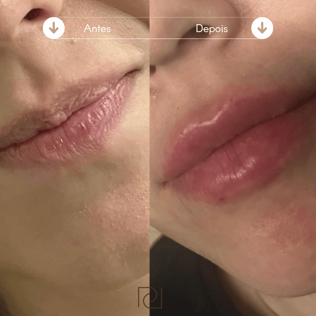 Preenchimento Labial Resultado Antes e Depois 2