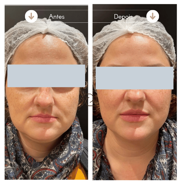 Preenchimento Labial Resultado Antes e Depois 3