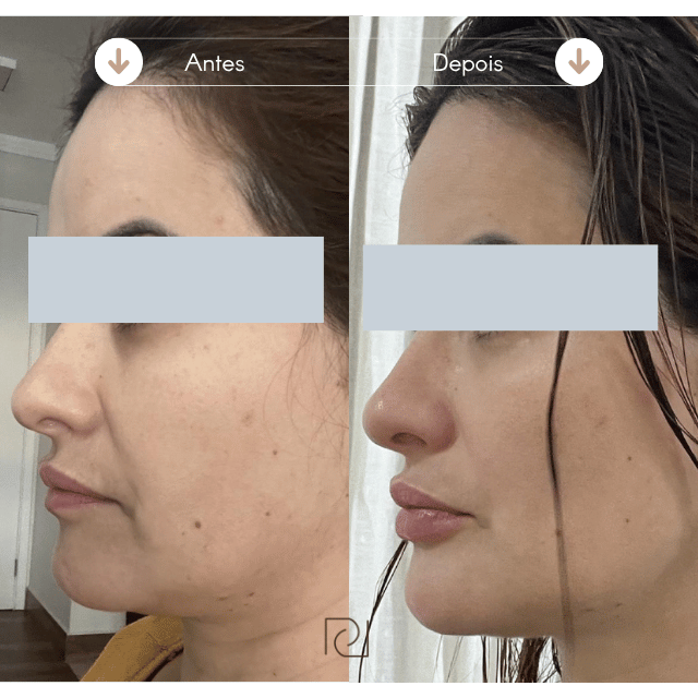 Preenchimento Labial Resultado Antes e Depois