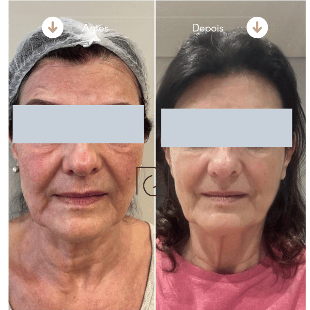 Resultado Harmonização Facial