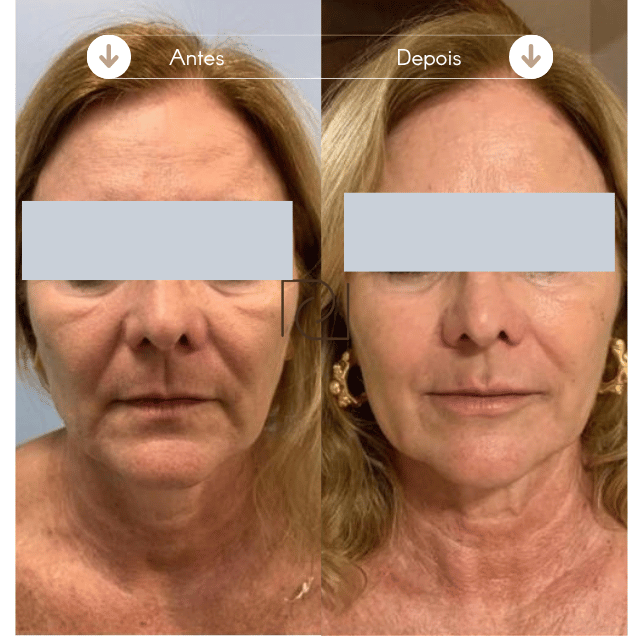 Resultado Harmonização Facial2